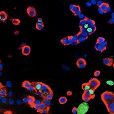 Betazellen des Menschen (rote Insulinfärbung) können sich teilen (grüne Zellkerne, in denen gefärbte, neu eingebaute DNA angereichert ist, im Unterschied zu den ausschliesslich blauen Kernen)- vielleicht mittels Bace2 Inhibierung auch im Diabetiker? (Bild: aus Esterhazy et al., 2011)